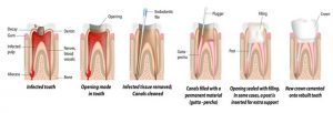 root canal treatment templestowe
