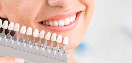 Veneers in Encino
