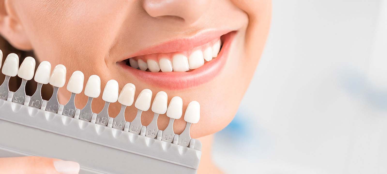 Veneers in Encino